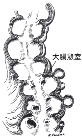 大腸憩室