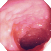 潰瘍性大腸炎　画像