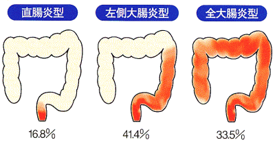 潰瘍性大腸炎 Step3 大腸 肛門病の知識 痔プロ Com