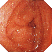 潰瘍性大腸炎　軽症