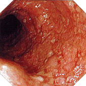 潰瘍性大腸炎　中等度