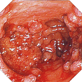 潰瘍性大腸炎　強度