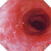 潰瘍性大腸炎　緩解期