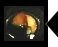 大腸ポリープ切除