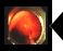 大腸ポリープ切除