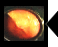 ポリープ切除出血防止法