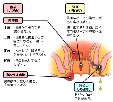 主な痔の疾患